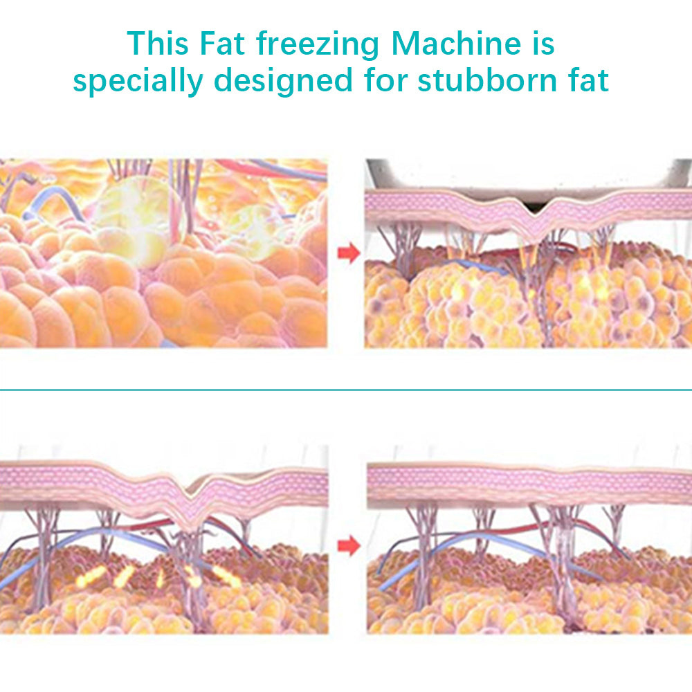 Fat Freezing Body Sculpting XYZDreams