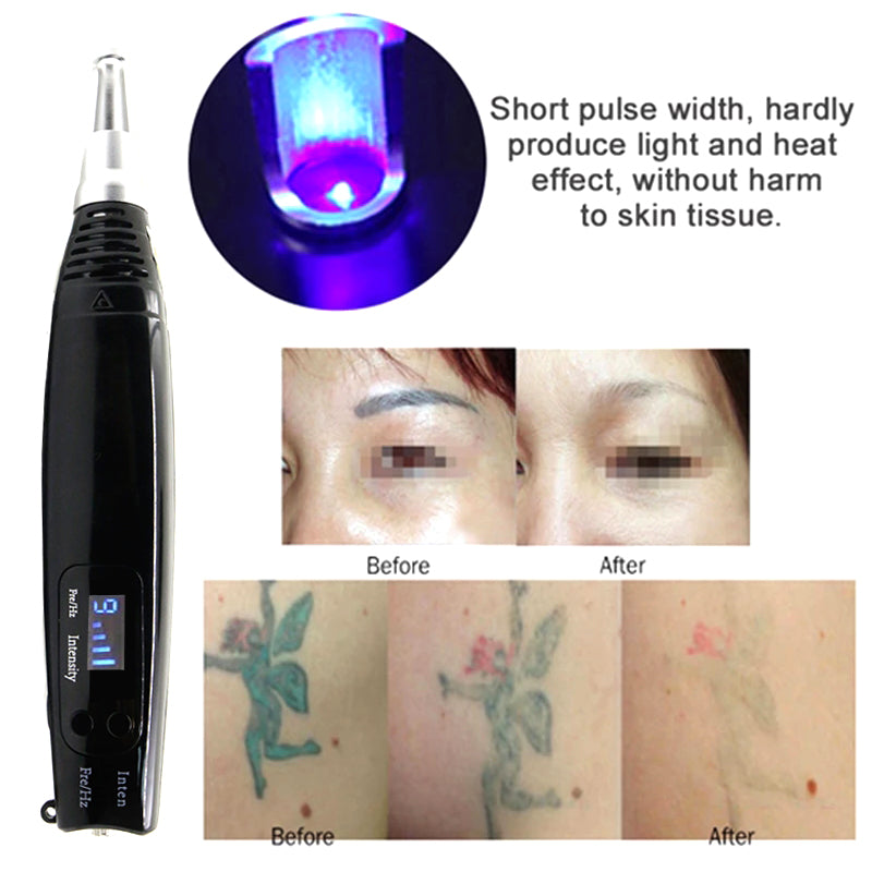 Picosecond Laser Therapy Pen XYZDreams